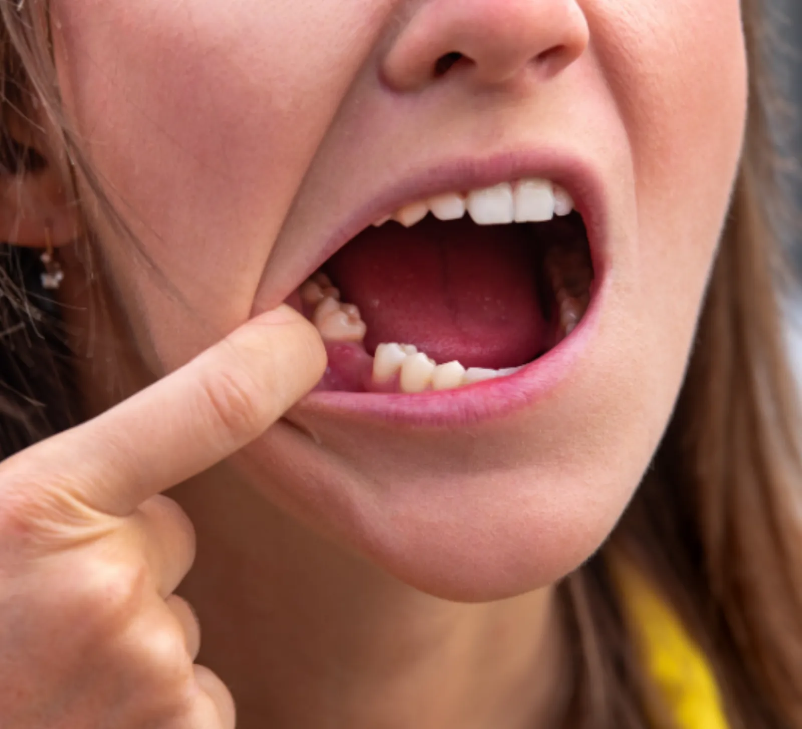 Tooth Extractions at High River Dental Centre